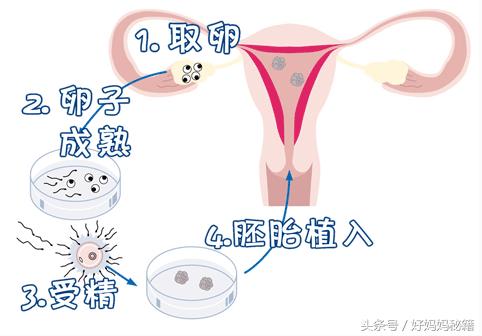 丙肝可以做试管婴儿(有丙肝的妇女能做试管婴儿吗)