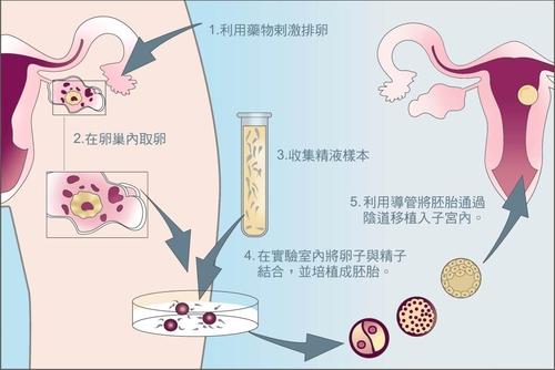 第四军医大学西京医院试管婴儿长方案过程