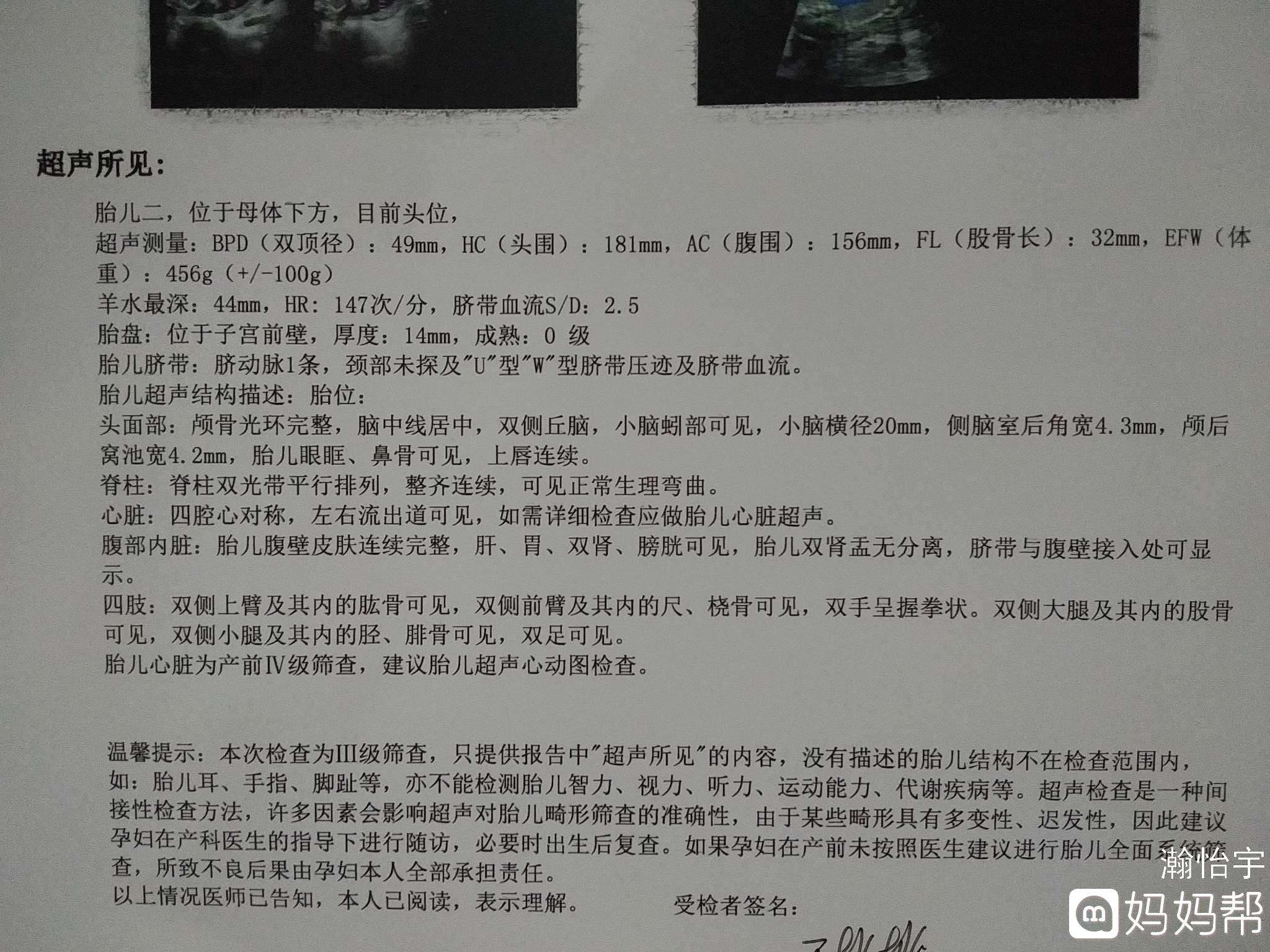 试管婴儿单脐二代试管婴儿胚胎质量