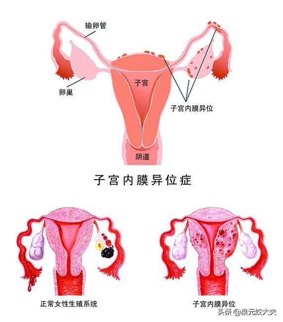 子宫内膜异位症试管婴儿轻微腺肌症做试管婴儿