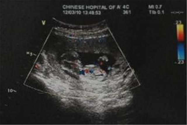 试管婴儿nt 试管婴儿nt