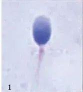 精子畸形试管婴儿 精子畸形试管婴儿