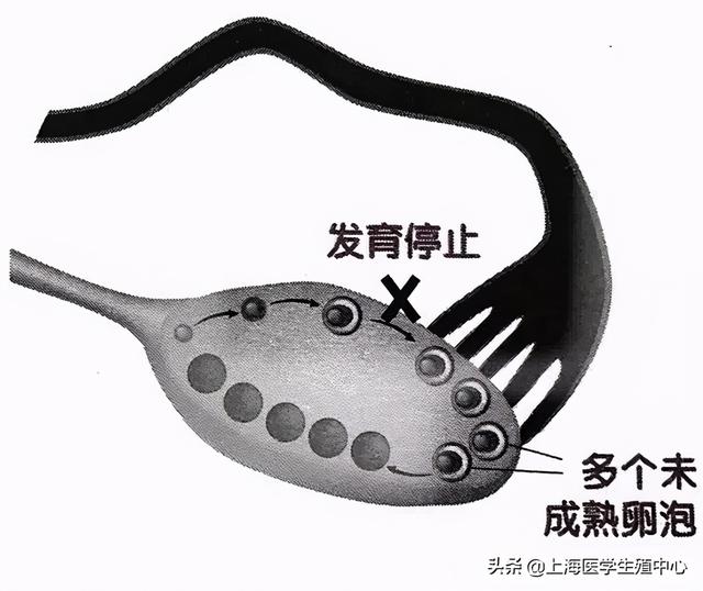 试管婴儿多囊卵巢 试管婴儿多囊卵巢