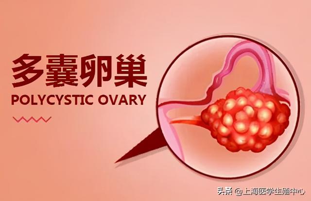 试管婴儿多囊卵巢 试管婴儿多囊卵巢