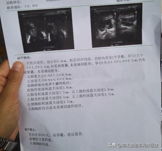 试管婴儿腹水症状 试管婴儿腹水症状