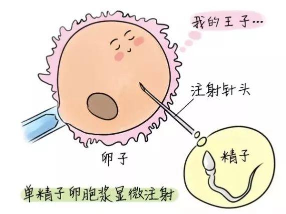 二代试管婴儿详细 二代试管婴儿详细