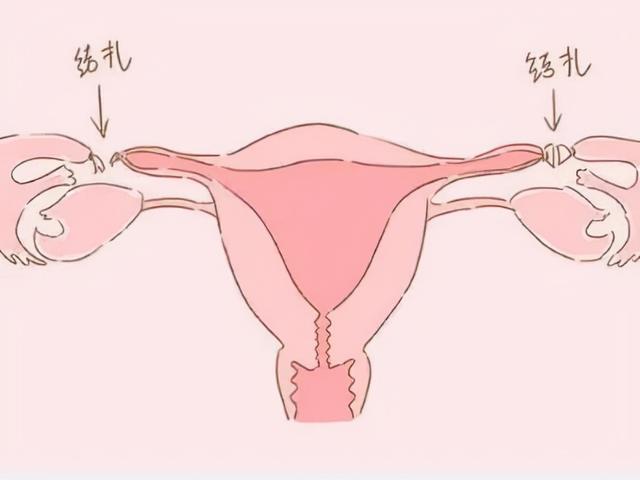 试管婴儿会宫外孕 试管婴儿会宫外孕
