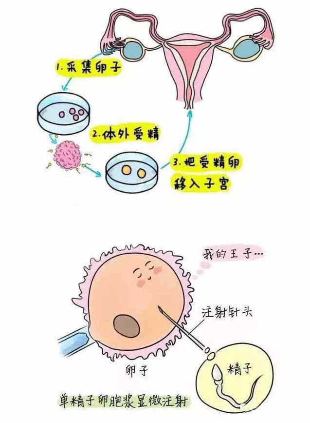 试管婴儿就成功了一个(试管婴儿步骤过程详细)