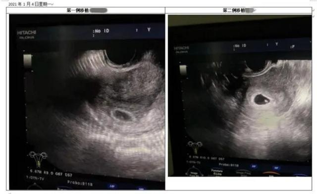 南方医院试管婴儿 南方医院试管婴儿