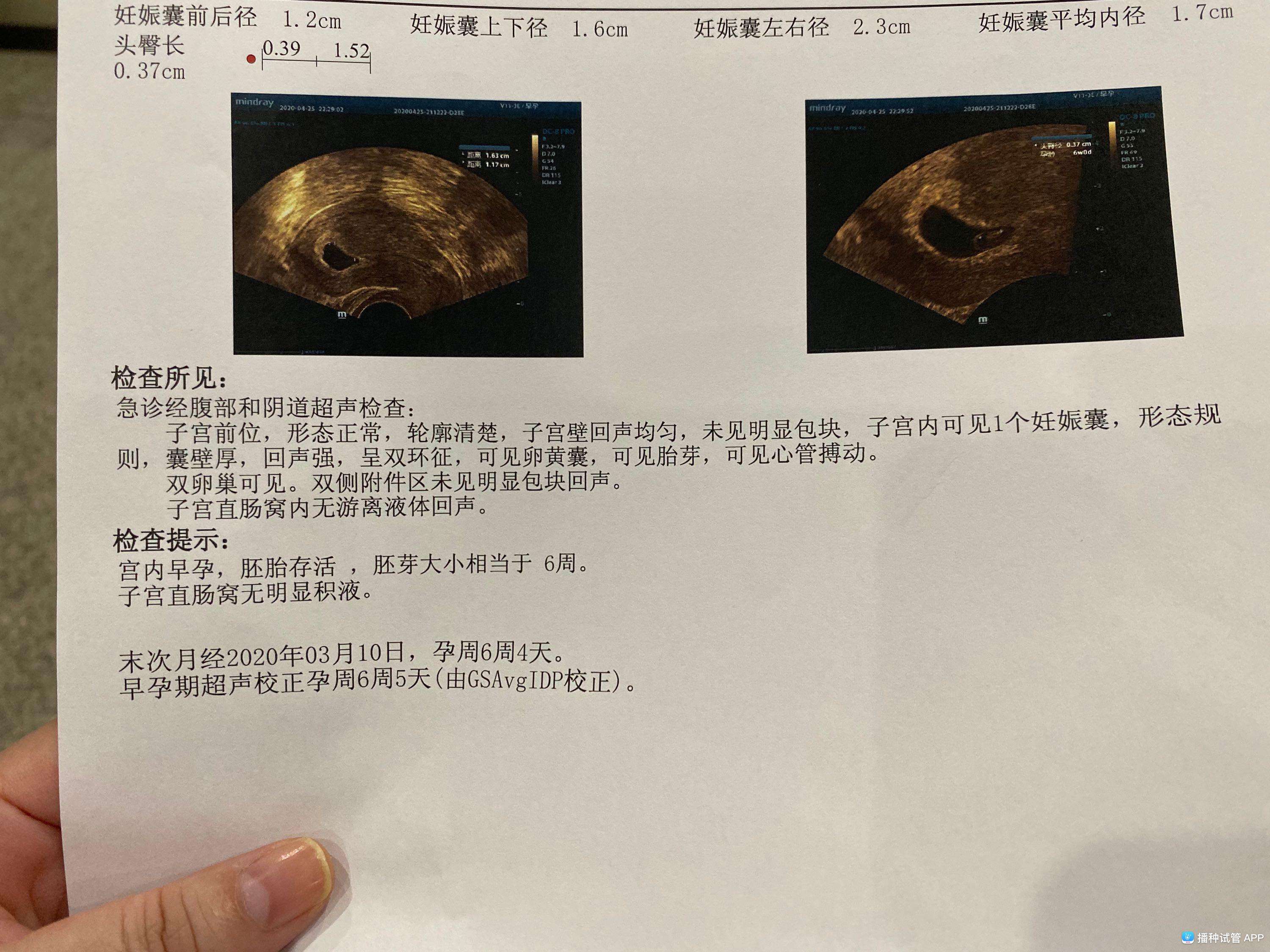 试管婴儿没胎心(试管婴儿怎么做的全过程)