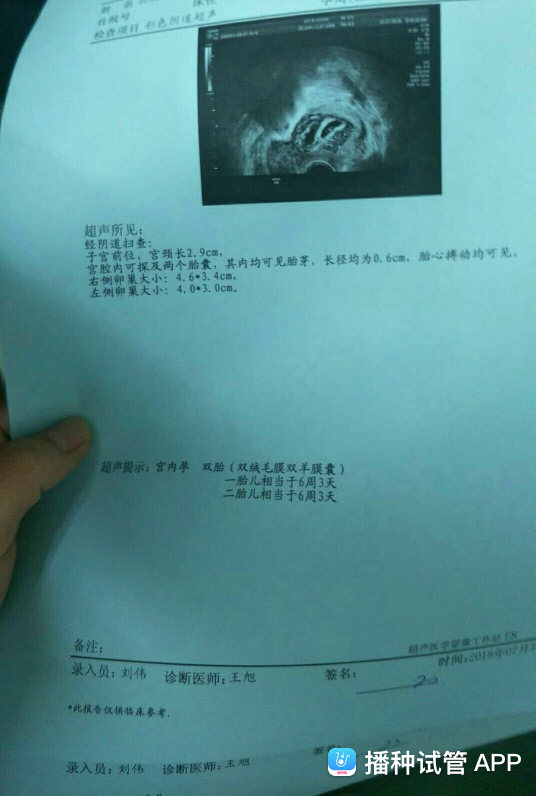 试管婴儿记录做试管婴儿的全部流程