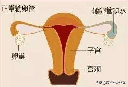 输卵管积水试管婴儿输卵管积水最佳治疗