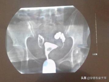 输卵管积水试管婴儿 输卵管积水试管婴儿