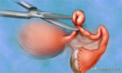 输卵管积水试管婴儿 输卵管积水试管婴儿