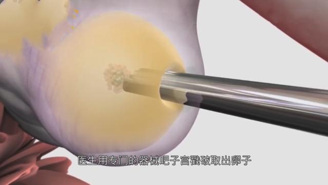 试管婴儿痛吗 试管婴儿痛吗