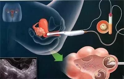 试管婴儿取卵痛吗 试管婴儿取卵痛吗