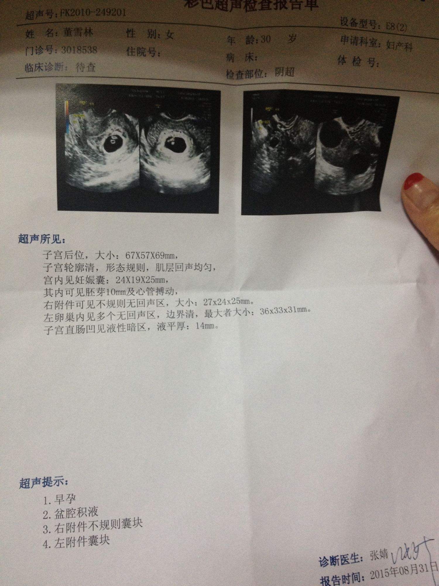 输卵管积液对试管婴儿有影响吗输卵管积水和试管婴儿