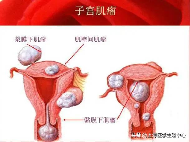 子宫肌瘤试管婴儿 子宫肌瘤试管婴儿