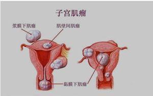 子宫肌瘤试管婴儿吗 子宫肌瘤试管婴儿吗