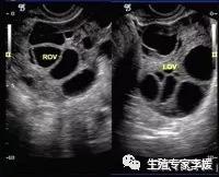 试管婴儿如何取卵泡取卵泡从哪里取