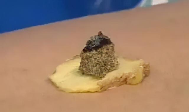 艾灸试管婴儿 艾灸试管婴儿