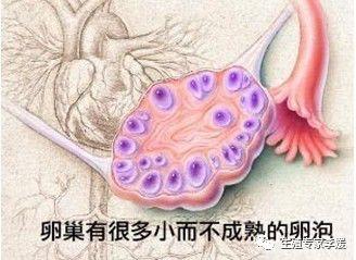 多囊卵巢试管婴儿 多囊卵巢试管婴儿