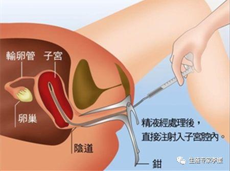 试管婴儿人工授精区别 试管婴儿人工授精区别
