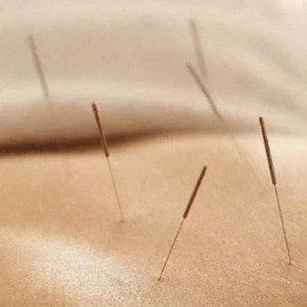 针灸试管婴儿 针灸试管婴儿