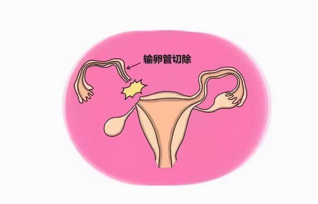 输卵管切除后可以做试管婴儿吗输卵管切除还能接上吗