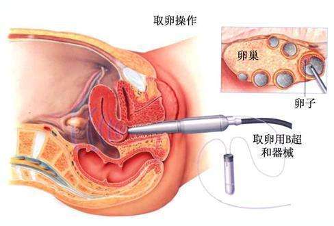 试管婴儿经历分享(试管婴儿长大后的弊端)