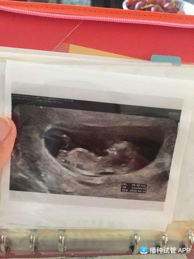 试管婴儿肚型做试管婴儿需要多少天