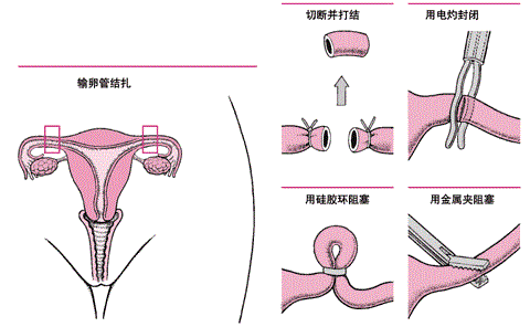 试管婴儿结扎 试管婴儿结扎