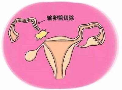 试管婴儿结扎 试管婴儿结扎