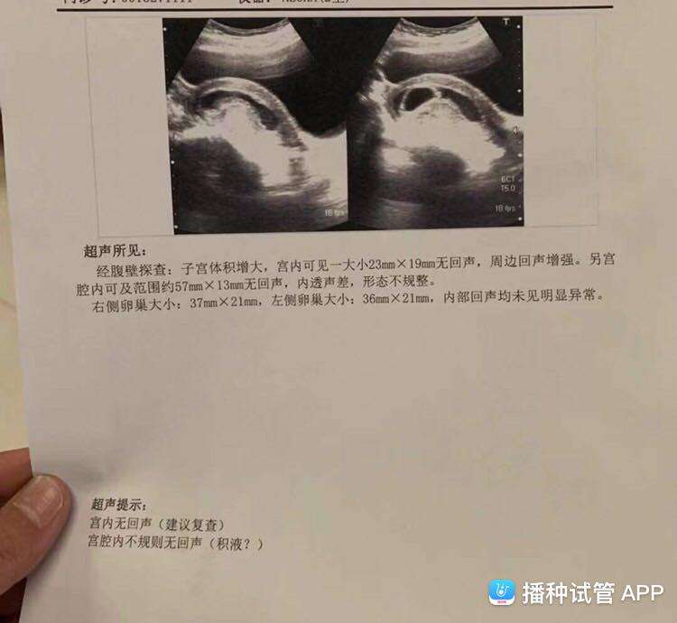 试管婴儿32天冻胚移植3天成功的征兆