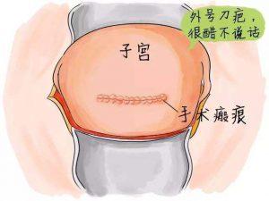 试管婴儿必须刨腹产吗 试管婴儿必须刨腹产吗
