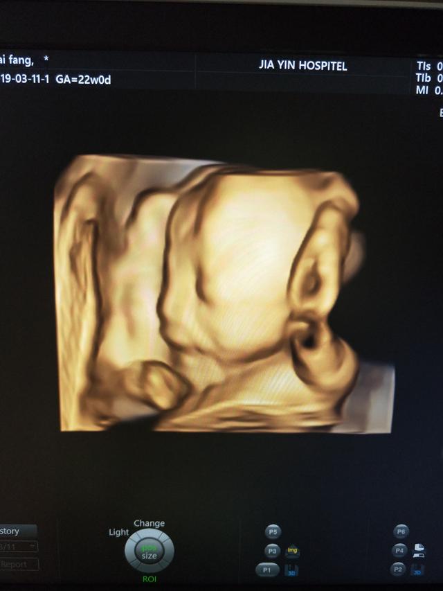 试管婴儿糖耐 试管婴儿糖耐