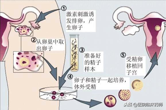 试管婴儿美国 试管婴儿美国