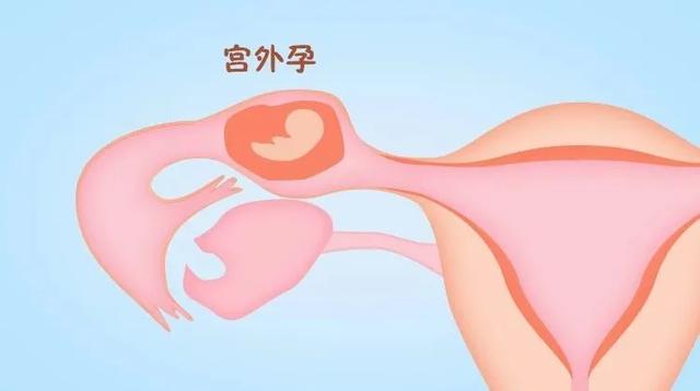 宫外孕做试管婴儿 宫外孕做试管婴儿