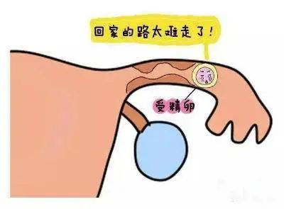 宫外孕做试管婴儿 宫外孕做试管婴儿