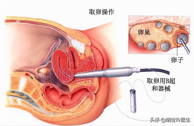 试管婴儿视频播放真实 试管婴儿视频播放真实