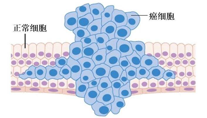 试管婴儿卵巢癌(试管婴儿用药后得乳腺癌)