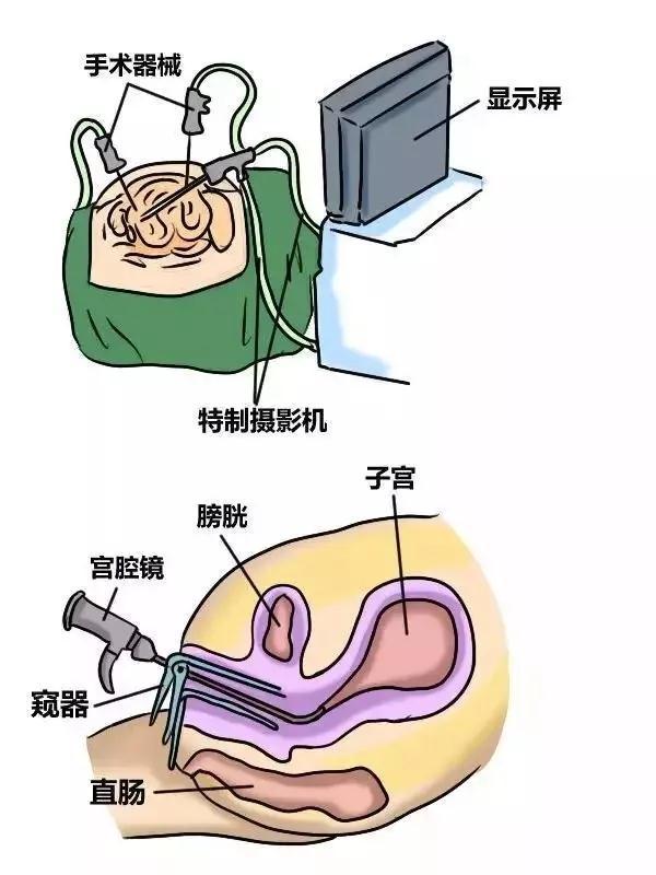 试管婴儿宫腔镜后(试管婴儿前做宫腔镜)