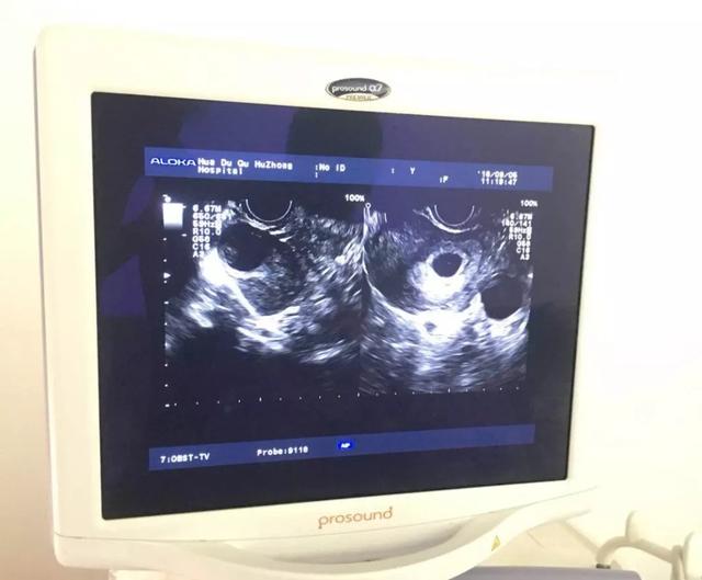 广州医院试管婴儿好 广州医院试管婴儿好