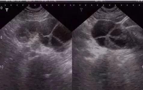 试管婴儿尿促 试管婴儿尿促