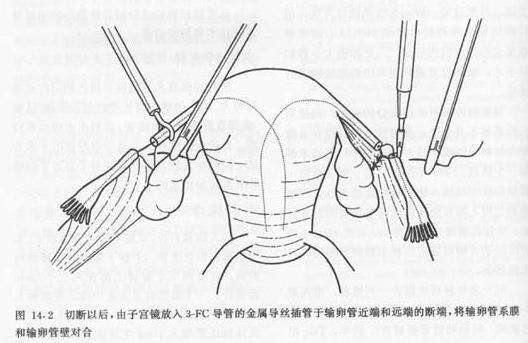 结扎还可以做试管婴儿 结扎还可以做试管婴儿