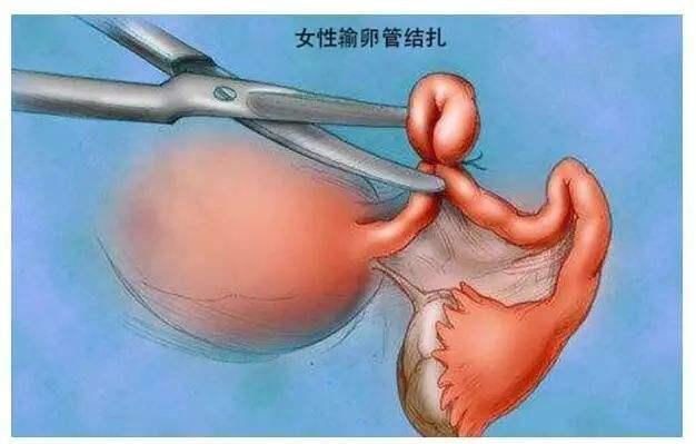 结扎还可以做试管婴儿做试管婴儿是谁的精子
