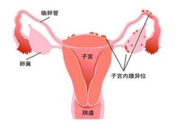 试管婴儿的人群