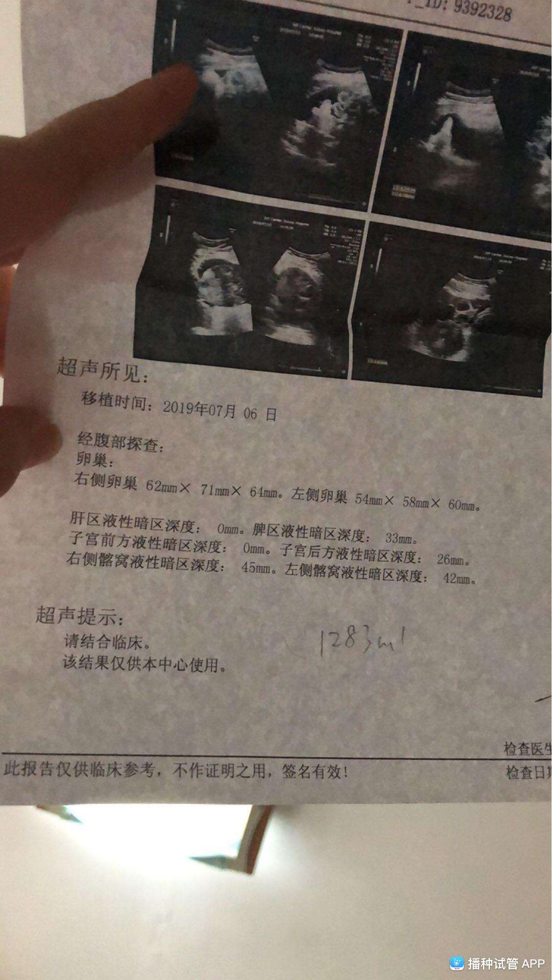 试管婴儿取卵腹水试管为什么会腹水