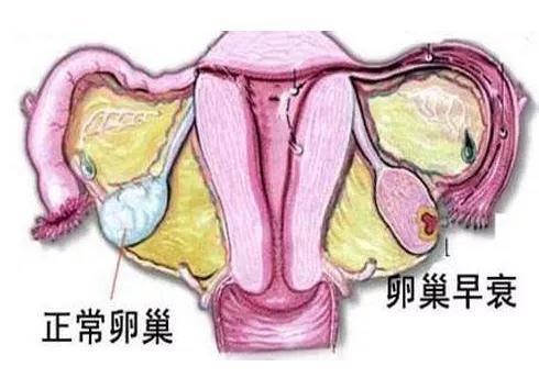 试管婴儿促排药 试管婴儿促排药