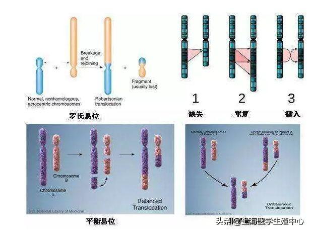 染色体异常试管婴儿 染色体异常试管婴儿